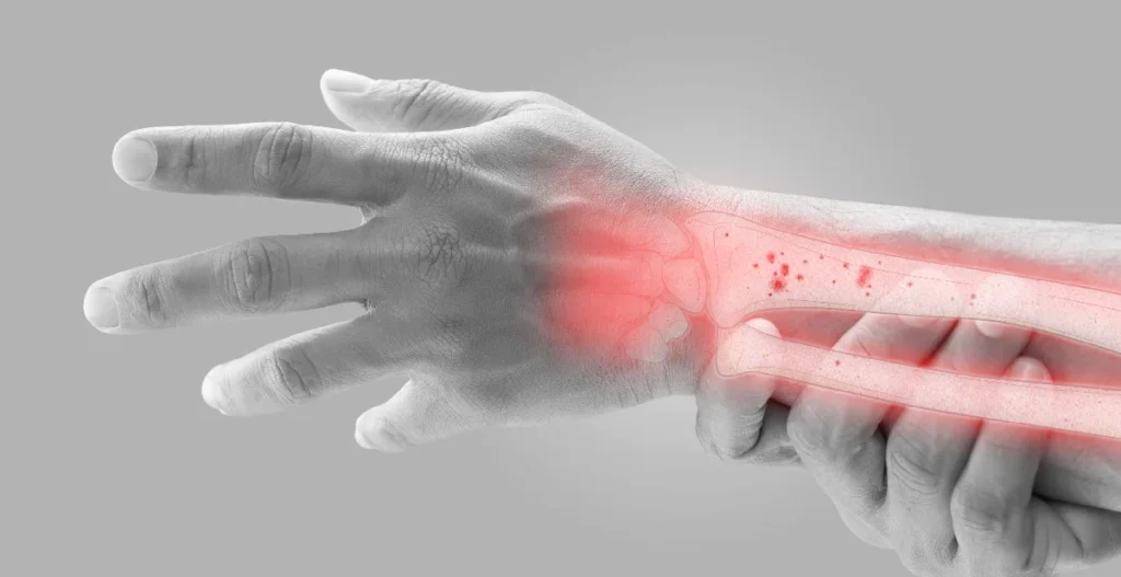 Tecido ósseo em remodelação — tratamento da osteoporose além do cálcio